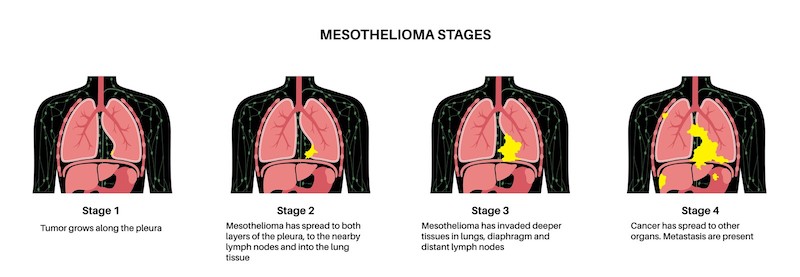 Mesothelioma stages
