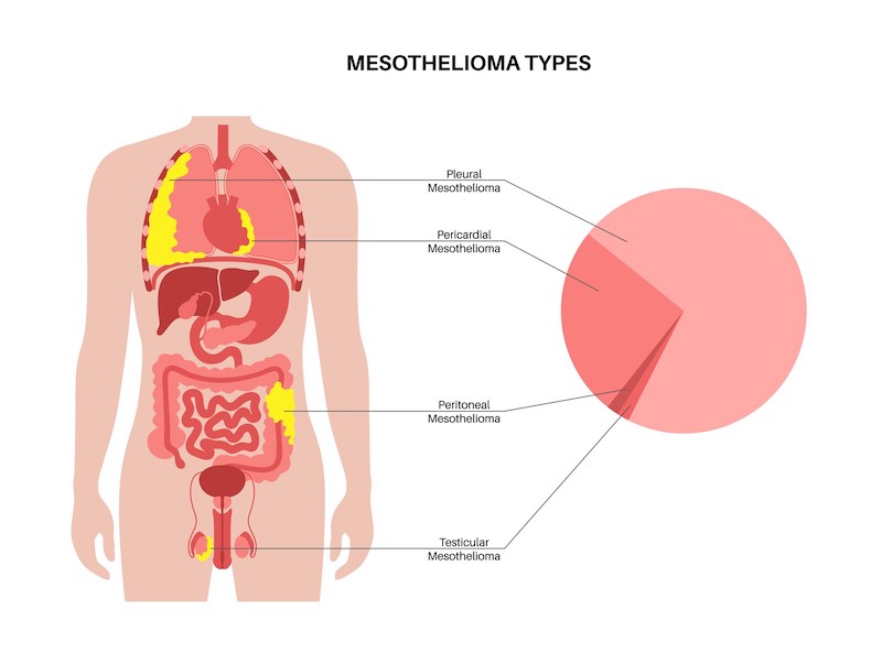 Types of mesothelioma image