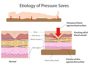 pressure-sores